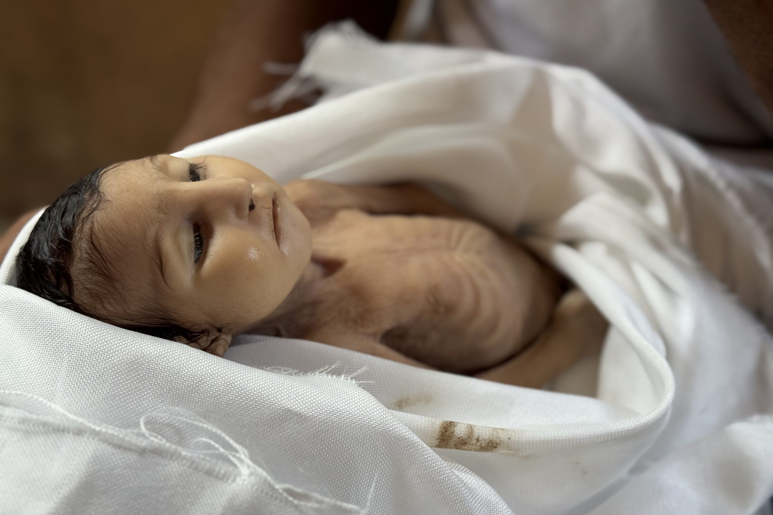 4 وفيات بينهم طفل نتيجة المجاعة وسوء التغذية خلال الـ24 ساعة الماضية